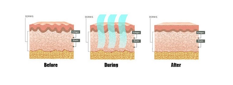 radiofrecventa faciala